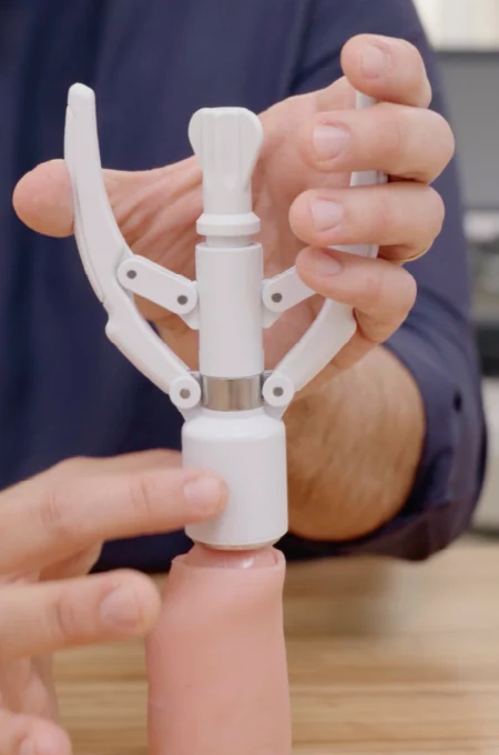 Tecnica_Operacion-Fimosis-Grapadora